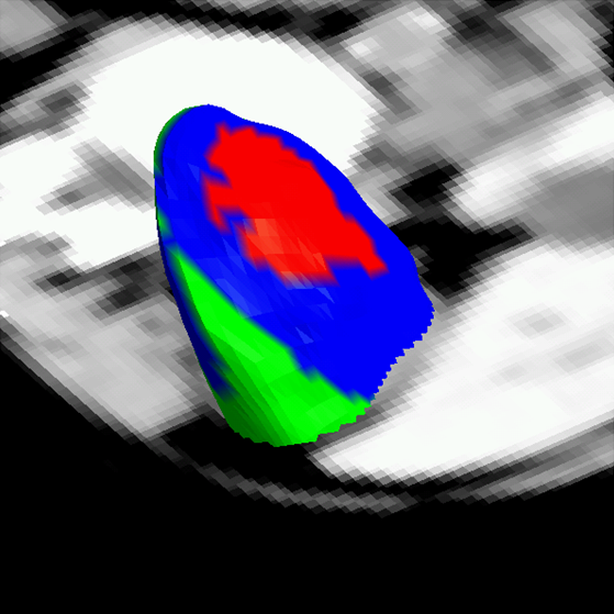 Kidney surface colored according to intensity profile type.