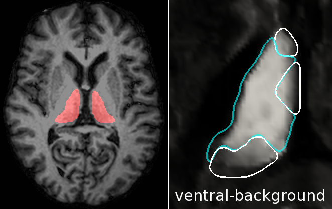 Example brain MRI with thalamus highlight, and ventral nucleus score image.