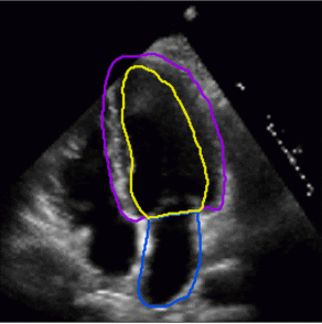 Left ventricle and atrial segmentation for four chamber echocardiography