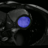 Left ventricle segmentation from CMR. blue:intersection green:automatic, red:manual.