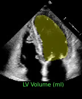 Fully automatic multi-beat echocardiography segmentation
