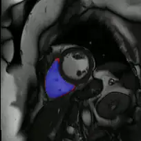 Right ventricle segmentation from short-axis CMR. Blue: intersection, green: automatic, red: manual.